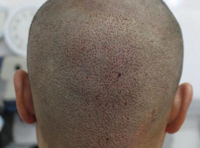 头上疤痕祛除方法有几种