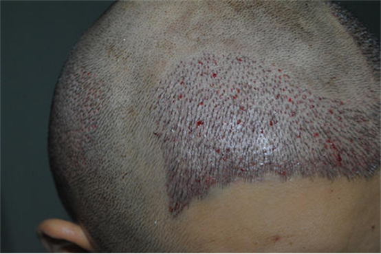疤痕植发恢复过程怎么样