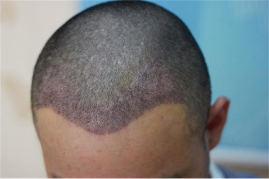 疤痕植发有危险吗