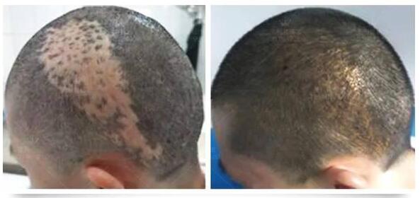 增生期疤痕能植发吗