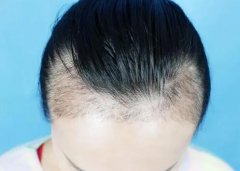 发际线高了怎么恢复，头发种植可以吗